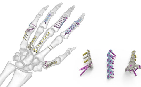 Types of Surgical Implanted Screws are There for a Broken Hand